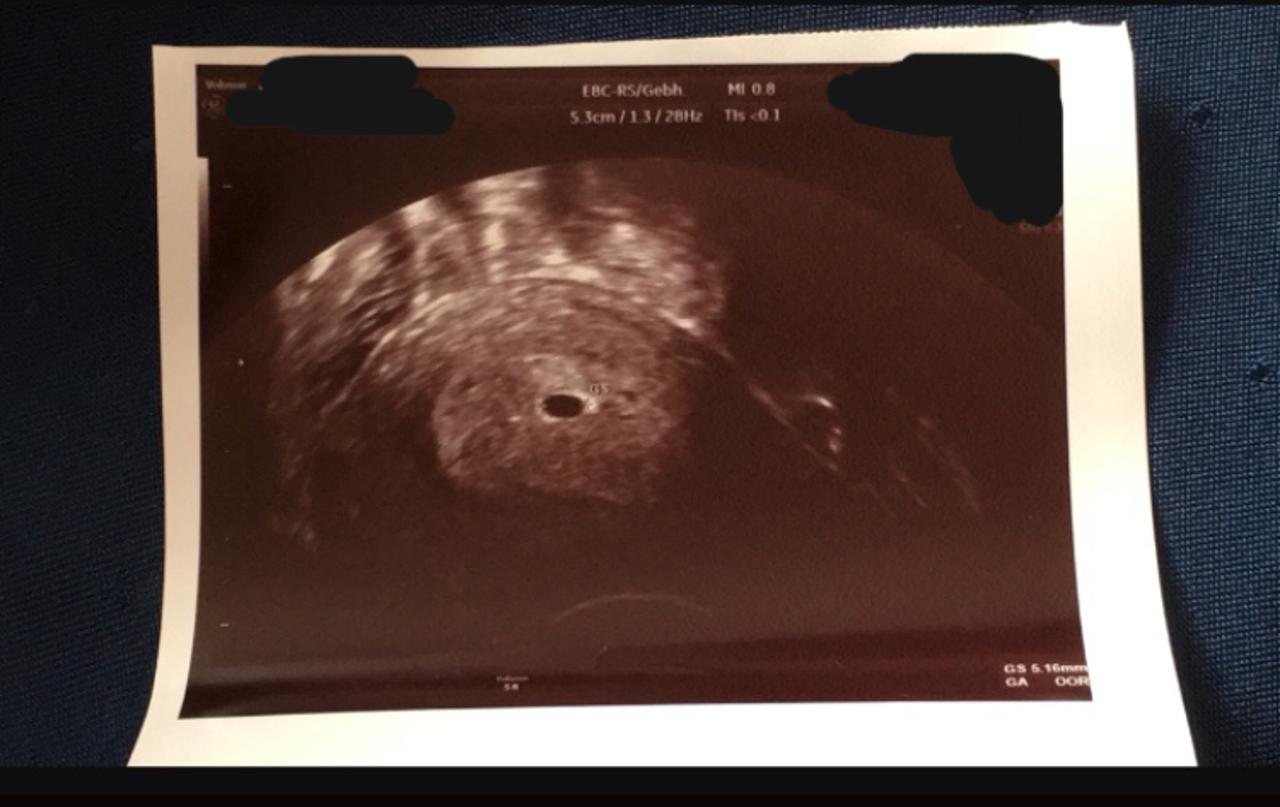 32++ Ultraschall bild 5 ssw , Ultraschall 5. SSW Verunsicherung vom Arzt Forum Schwangerschaft