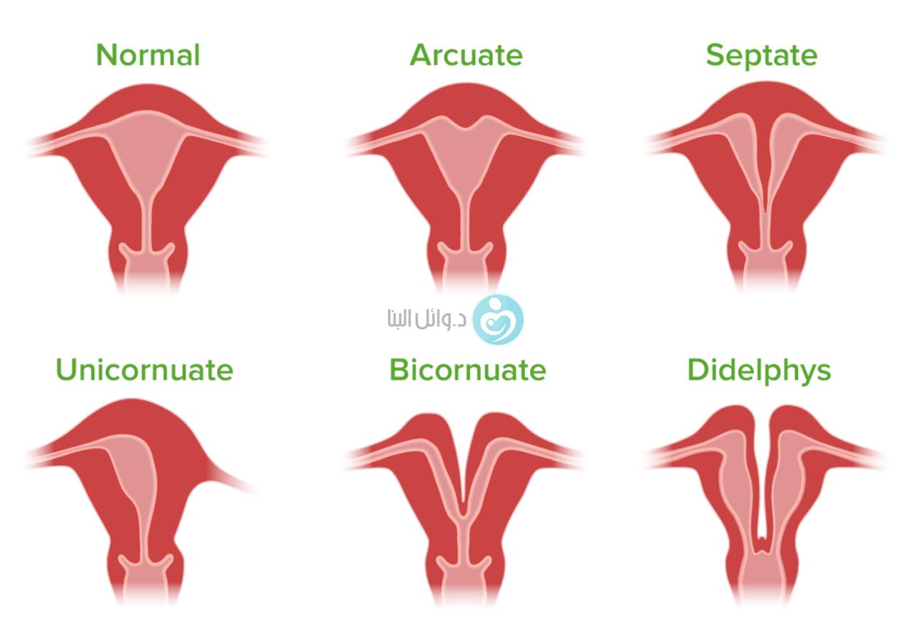 uterus-bicornis-op-forum-fr-hes-ende-urbia-de