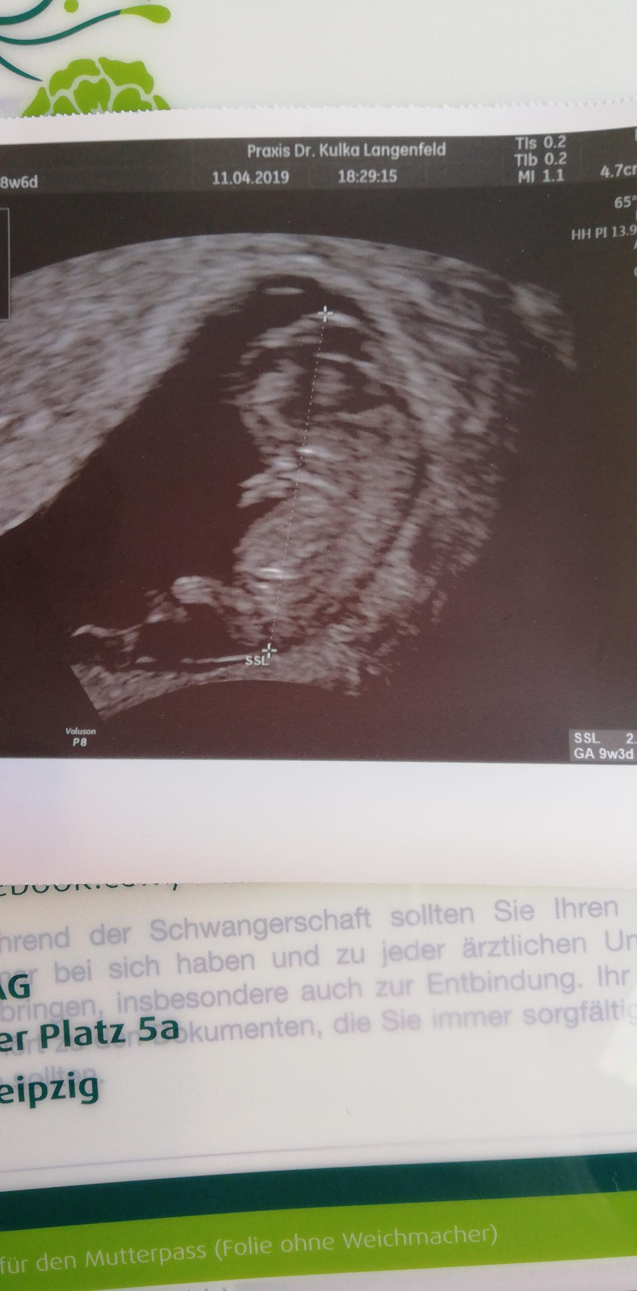 Ultraschallbild 9 ssw | Forum Schwangerschaft - urbia.de